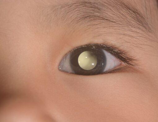 Retinoblastoma tem 90% de chance de cura quando diagnosticado precocemente